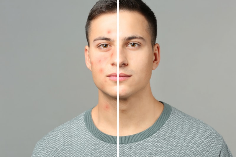 Blemishes Acne Problems Treatments