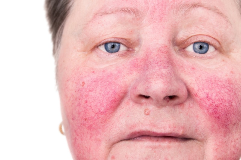Rosacea Redness Treatment and Skincare in Richmond