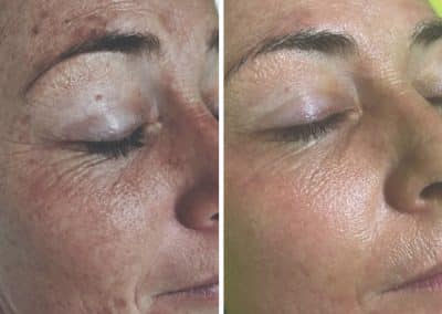 Aging Skin Concerns Before and After DMK Facials
